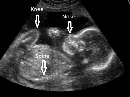 Pregnancy pictures ultrasound of Ultrasound Gallery