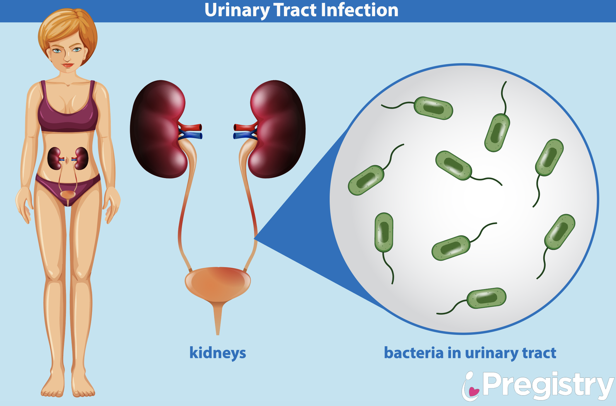 Urinary Tract Infection During Pregnancy