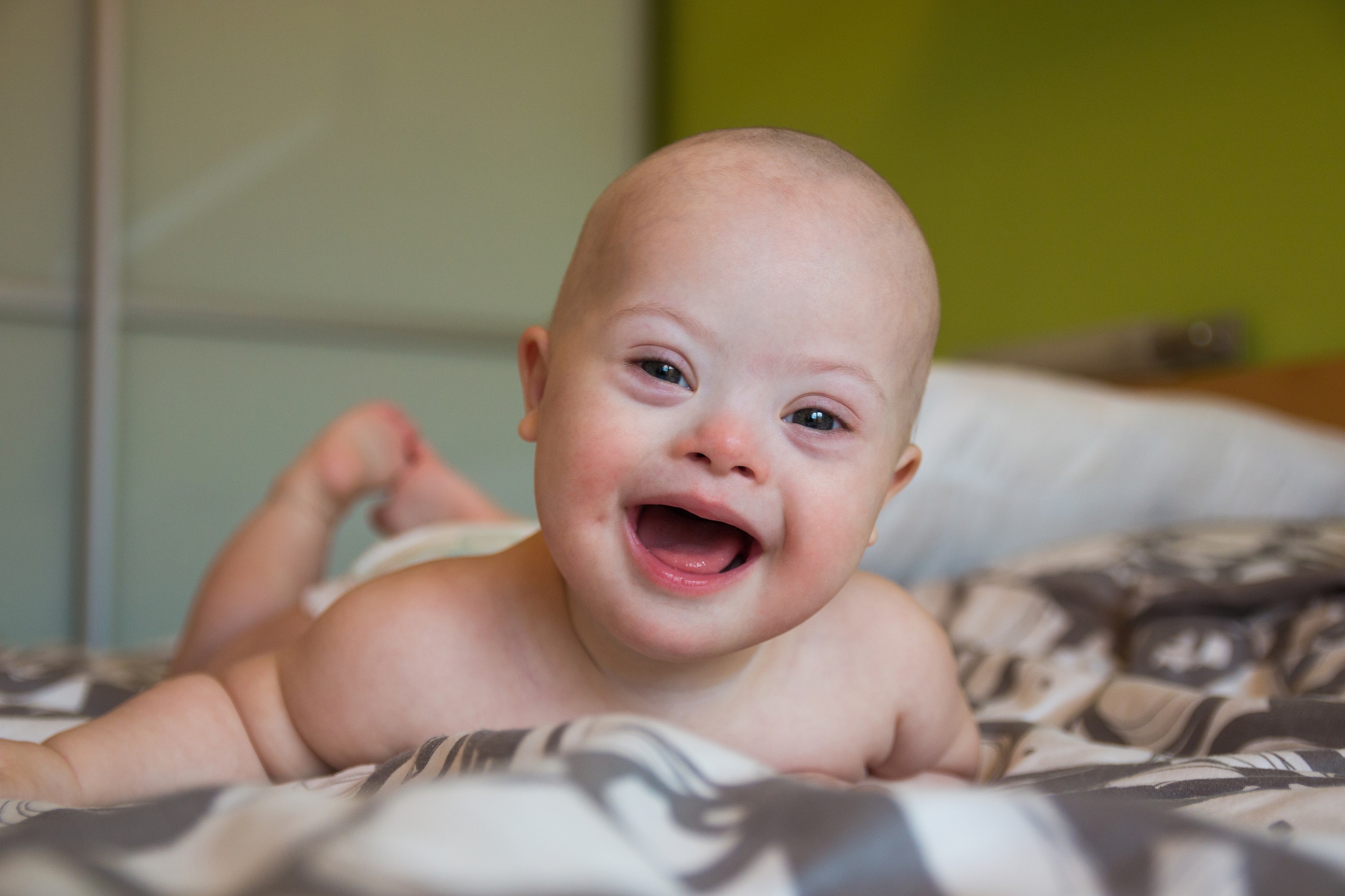 newborn baby with down syndrome pictures