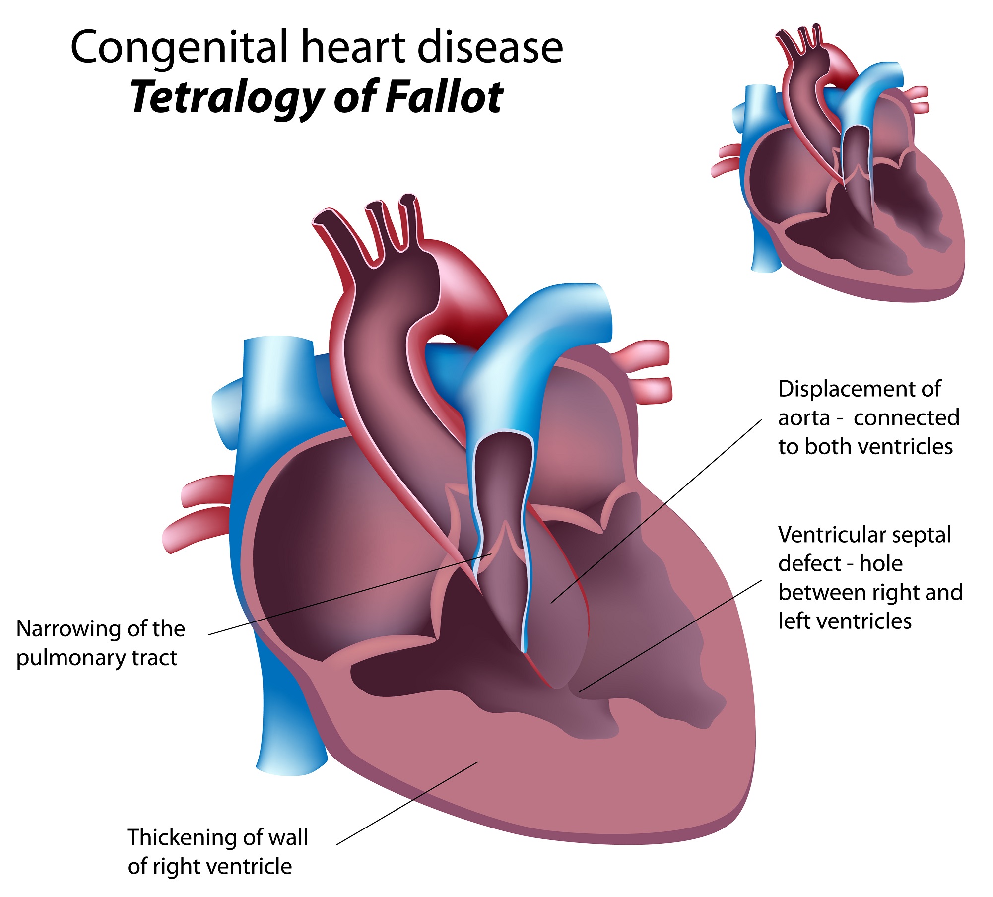 What Is Tetralogy Of Fallot? | The Pulse