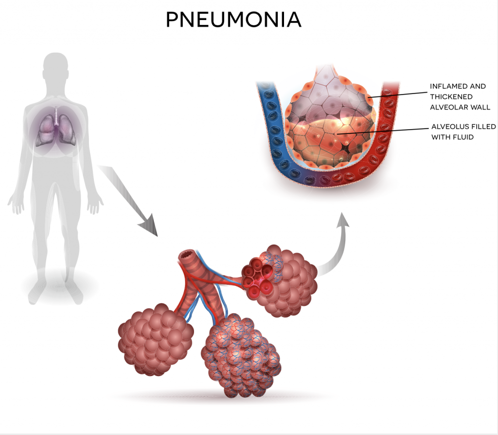 How Does Pneumonia Develop In Babies?