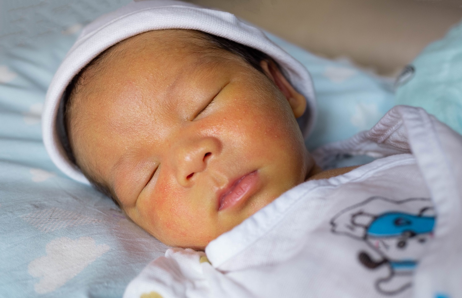 yellow skin colored neonatal jaundice happen in new born baby infant ...