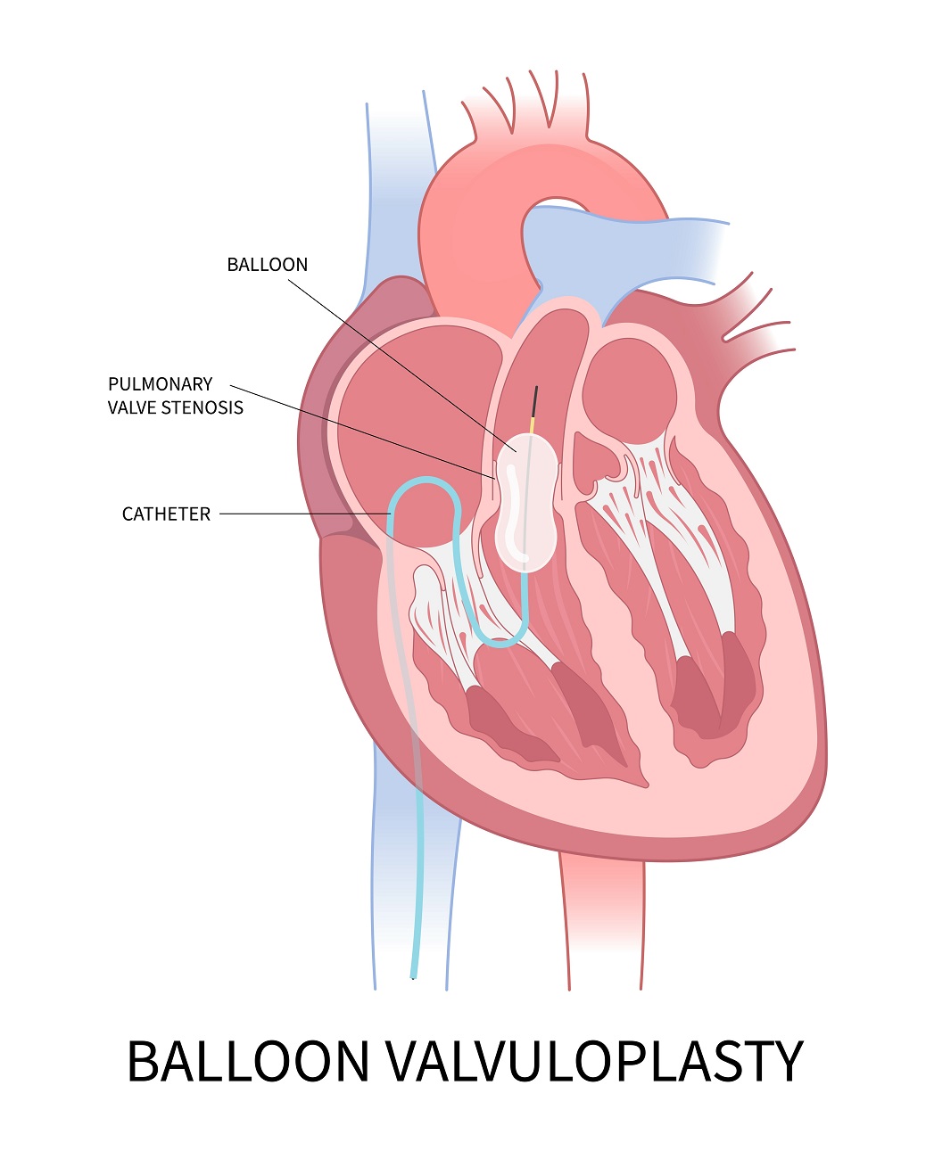 Congenital Pulmonary Stenosis and Truncus Arteriosus: Two Examples of  Congenital Heart Disease - The Pulse